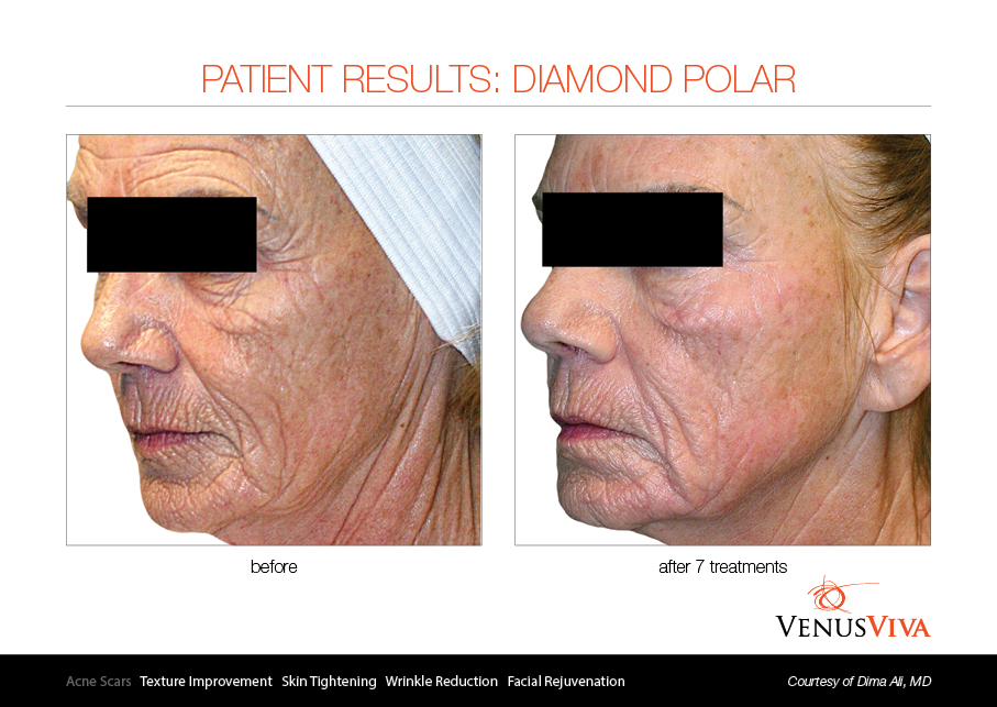 Venus Viva