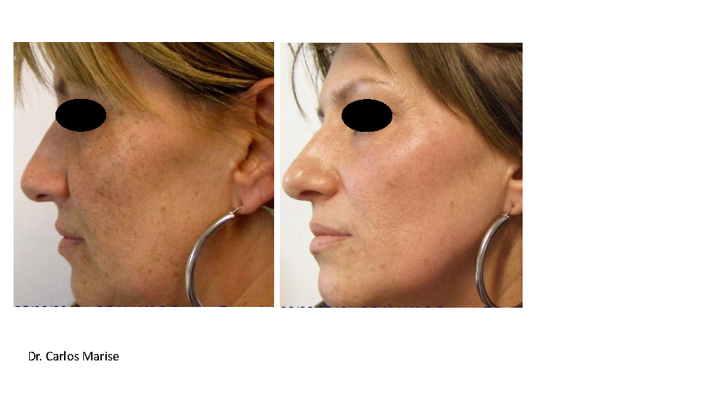 HarmonyXL Pro-Dye Mov. Rostro o Escote