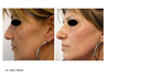 HarmonyXL Pro-Dye Mov. Rostro o Escote