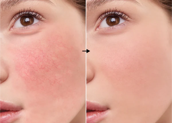 Rutin-TX 3% de la marca Universkin: Resultados