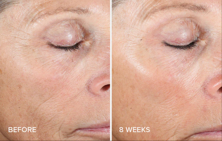 Active Peel System de la marca Is Clinical: Resultados en 8 semanas